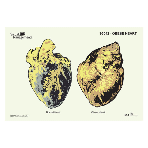 morbidly obese heart vs normal heart